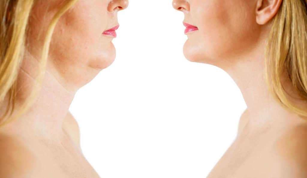 Double Chin treatment Bagshot before and after results