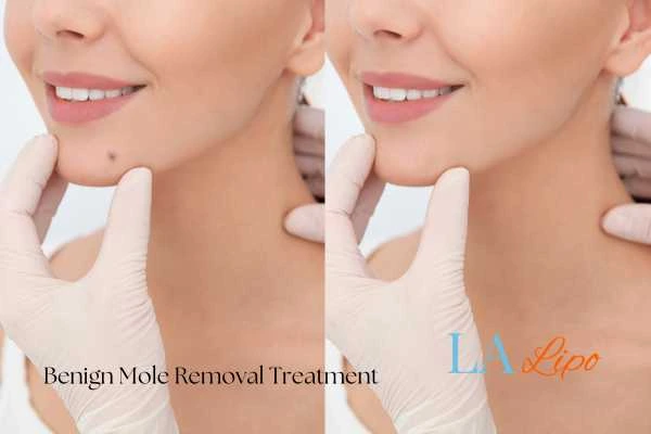 woman's before and after mole removal Bagshot results
