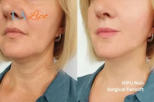 hi-fu for wrinkles Bagshot before and after results