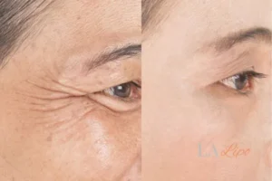 Before and after results of woman - HI-fu wrinkles reduction treatment Bagshot