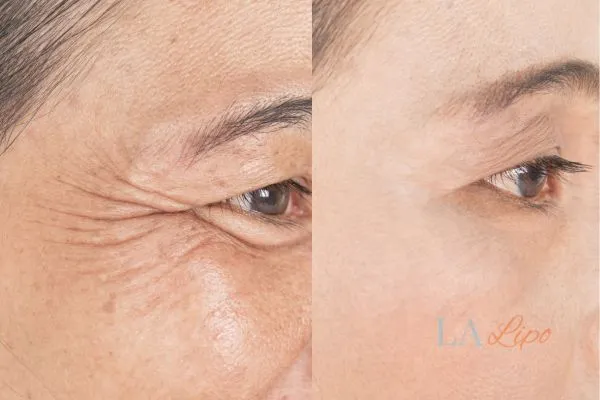 Before and after results of woman - HI-fu wrinkles reduction treatment Bagshot
