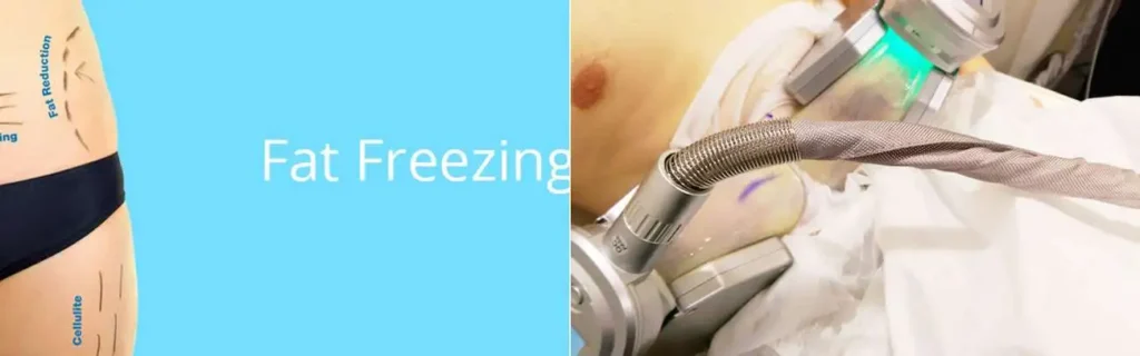 Fat freezing Bagshot on multiple areas of the body