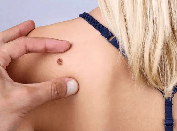woman having mole removal Bagshot consultation before treatment.