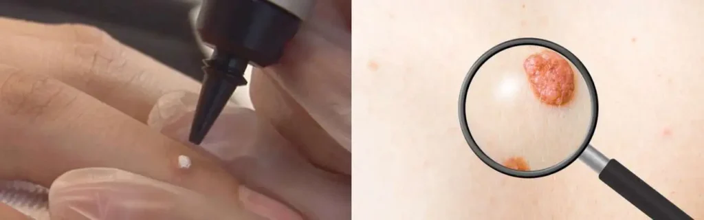 Cryopen for mole removal Bagshot - speak to our team today!