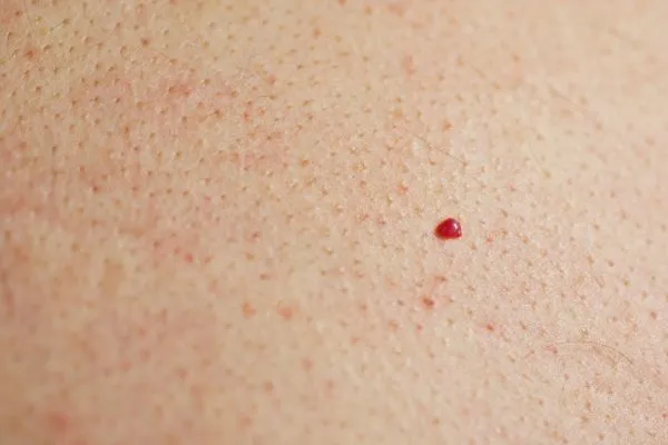 close up of a cherry angioma Bagshot