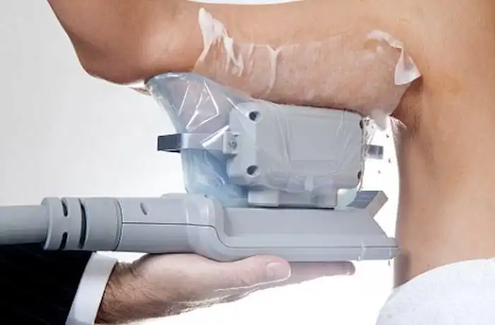 Picture of fat freezing Bagshot on the upper arms.