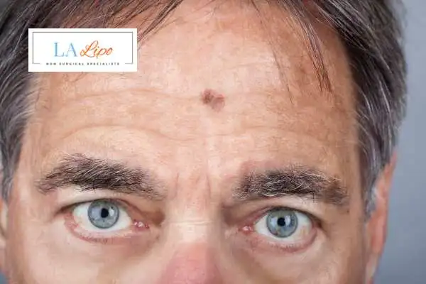 Solar Lentigo Removal Bagshot image of man with mark on his forehead