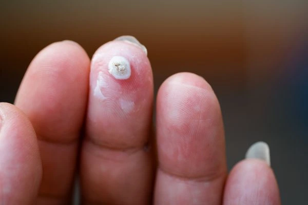 wart on person finger - cryotherapy to treat from LA LIPO Bagshot