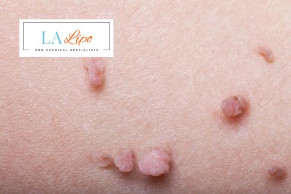 Does cryopen skin tag removal Bagshot hurt? Find out now call our team today!