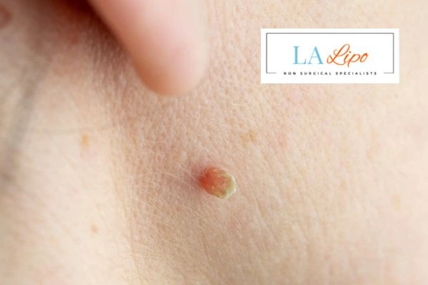 Book skin tag removal Bagshot today speak to our team now!