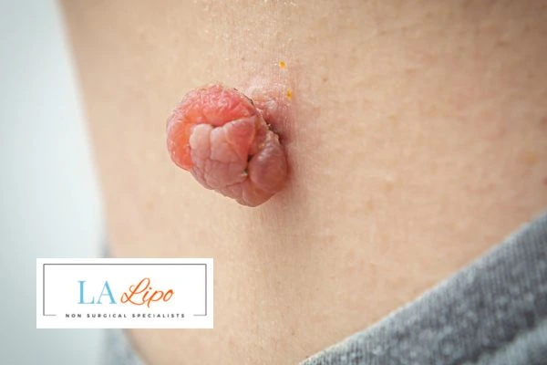Interested in skin tag removal Bagshot? Concerned about the pain? Find out more today!