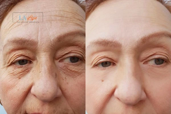 The powerful benefits of Morpheus8 Treatment Bagshot - Call Our team today!
