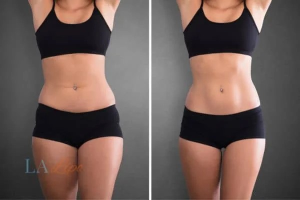 before and after results of non-surgical treatment to help a woman's body image and mental health Bagshot
