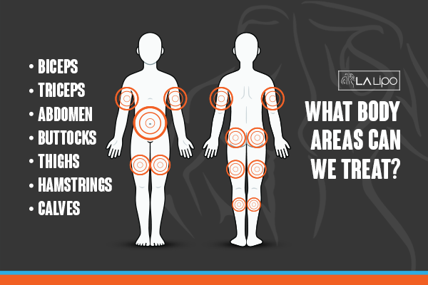 Diagram to show areas you can have LA-EMS Body Sculpting Treatment Bagshot