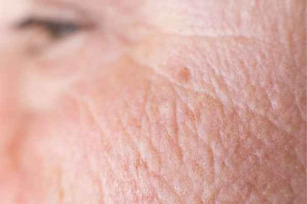 close up picture of a woman's face showing an age spot Bagshot