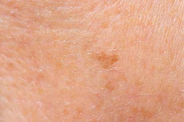close up picture of age spots Bagshot