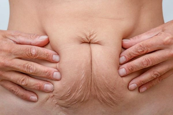Image of a woman's stomach with loose skin - example of skin tightening Bagshot options