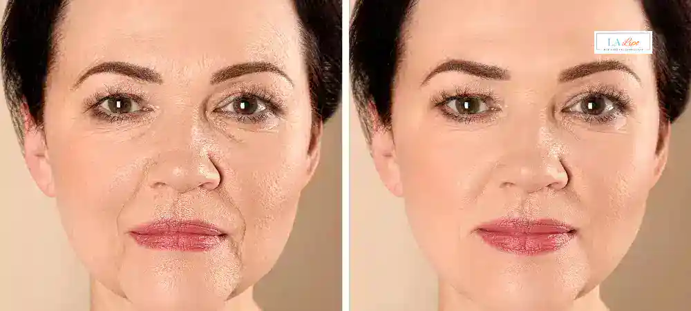How Long Does It Take to See Results and How Long Do They Last Bagshot?