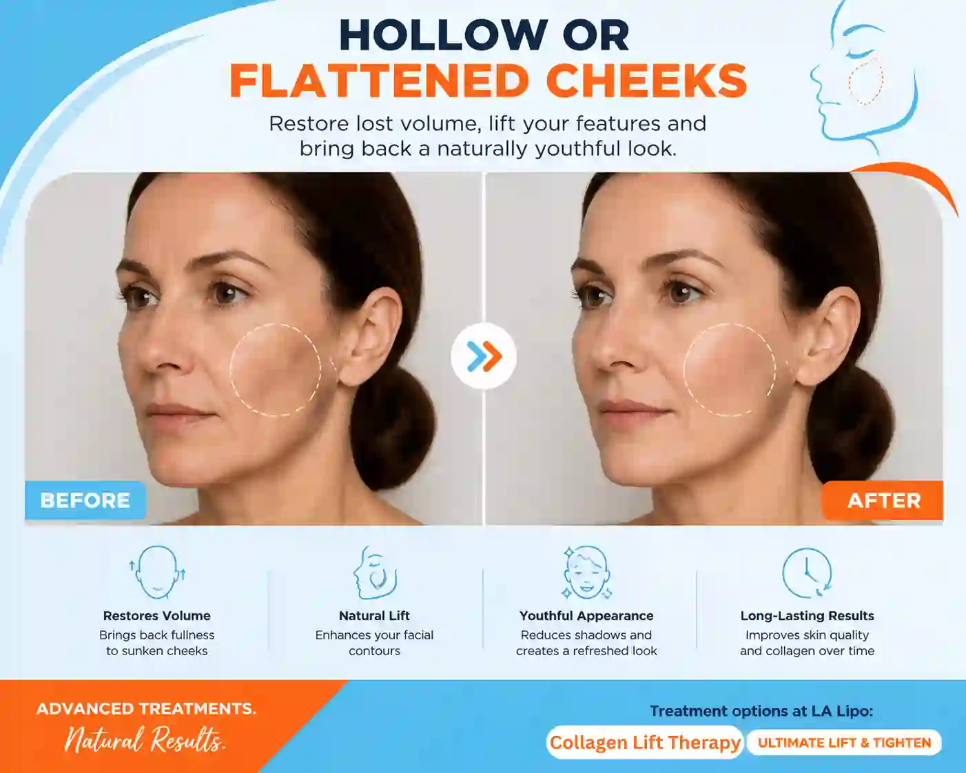 Sign #4: Hollow or Flattened Cheeks Bagshot