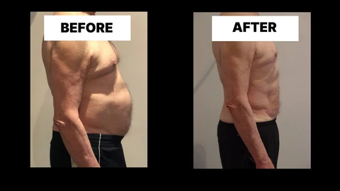 What Symptoms Can Diastasis Recti Cause in Men? Weak Core, Back Pain and Poor Posture Bagshot